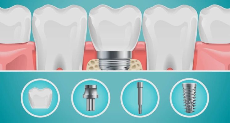 Implant Dentaire Tout Savoir Sur Les Implants Dentaires